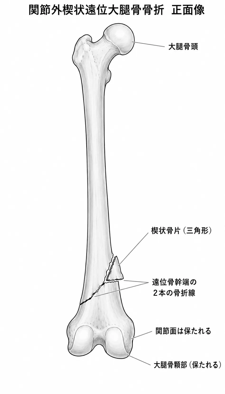 X線正面像 — 大腿骨遠位骨幹端の楔状骨折（楔状骨片と骨折線、関節面は温存）