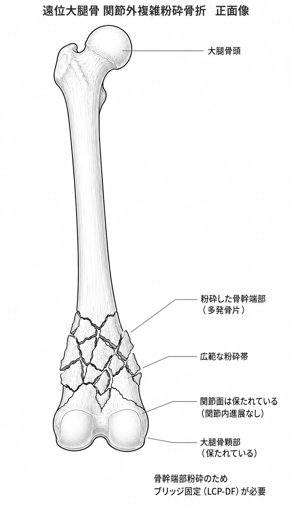 X線正面像 — 大腿骨遠位骨幹端の複雑粉砕骨折（関節面は温存）