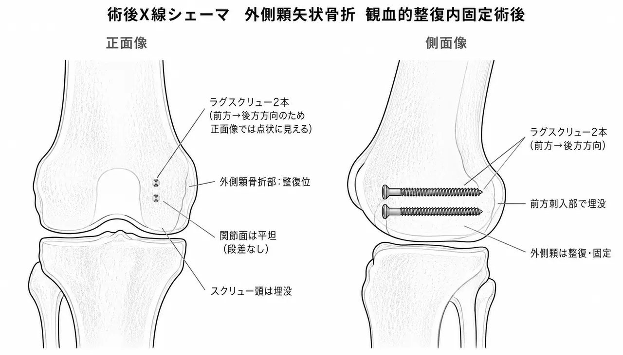 術後X線像（AP/側面）— 外側顆にL→M方向ラグスクリュー2本（countersunk）。関節面整復位