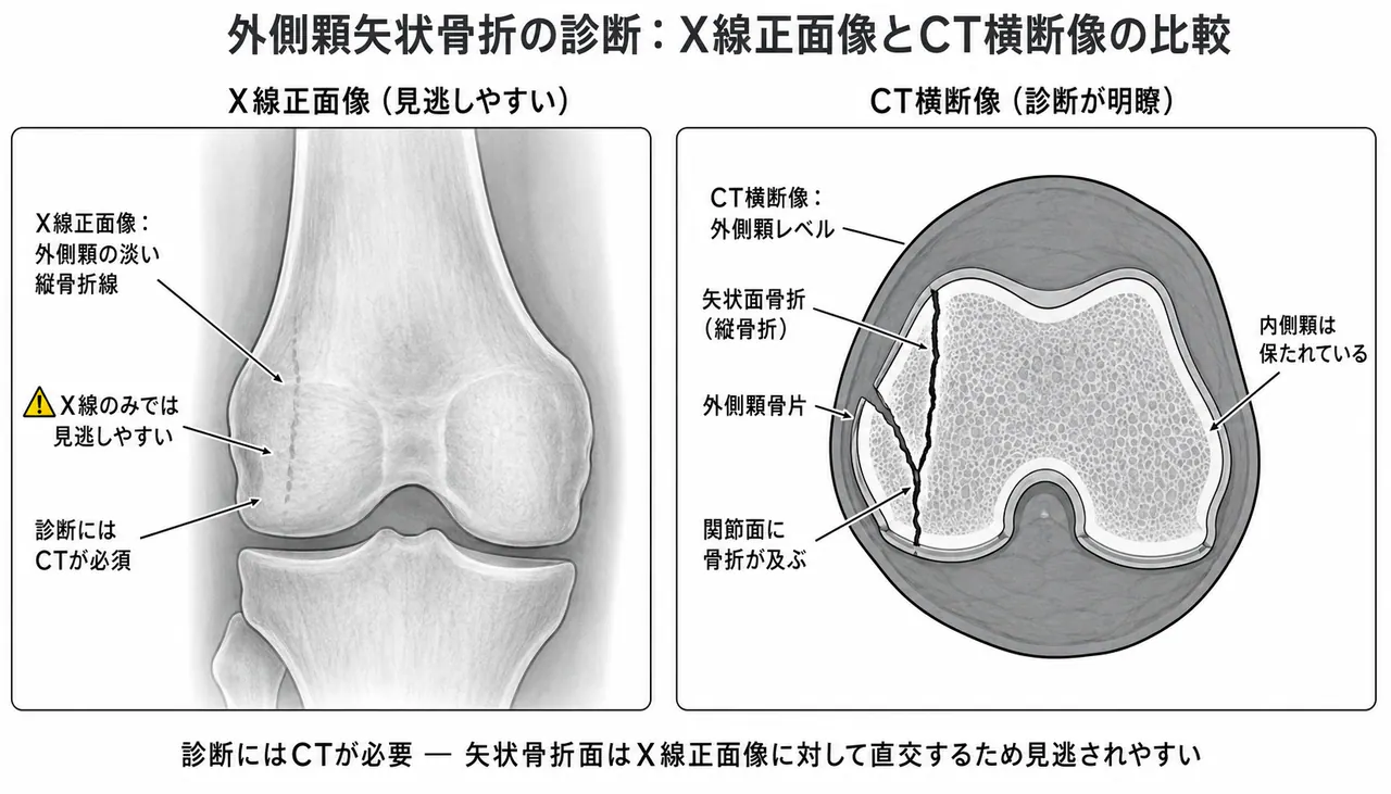 X線AP像（外側顆に縦骨折線）＋CT横断面（外側顆が矢状面で分割）— CT必須で診断
