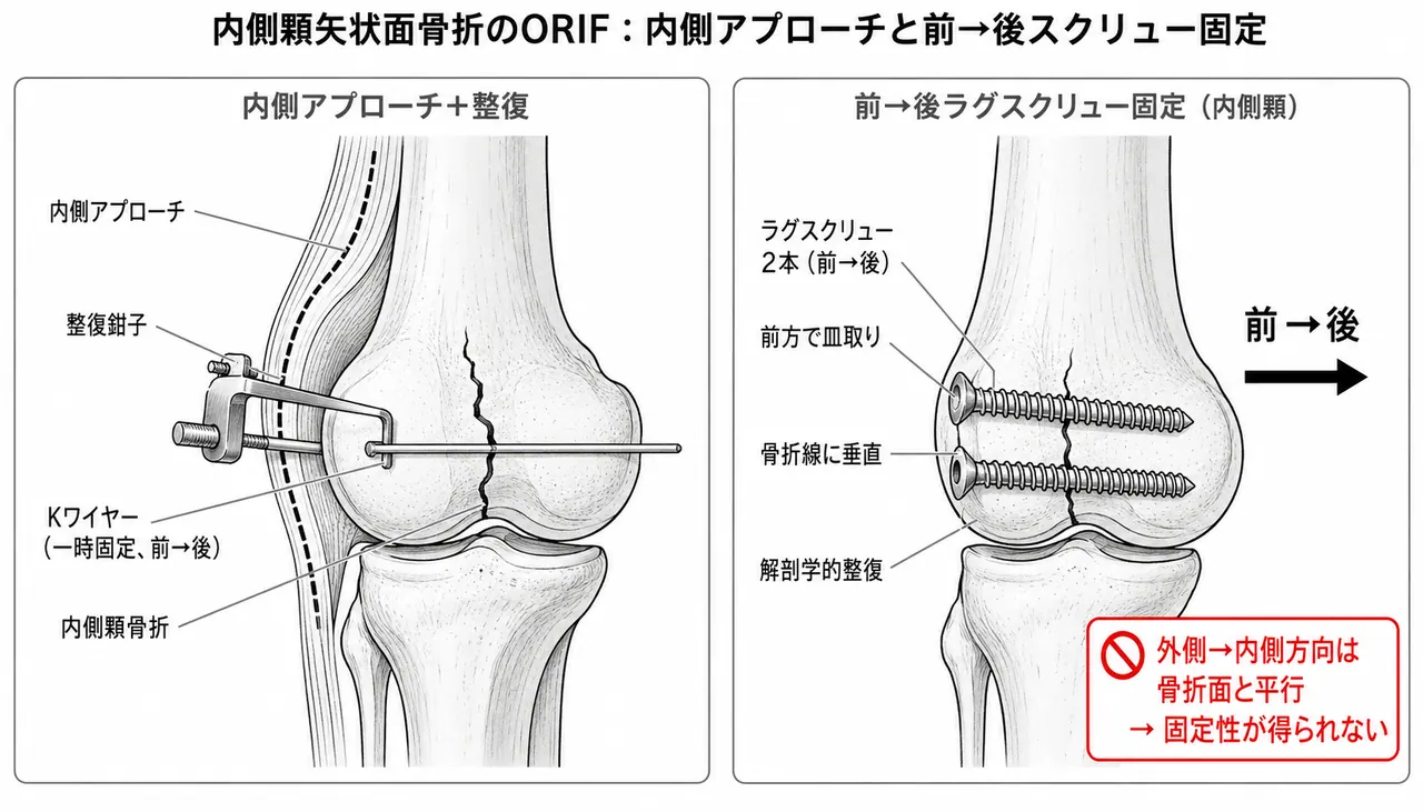 内側顆ORIF手技 — 内側アプローチ・M→L方向（内→外）ラグスクリュー固定・countersunk