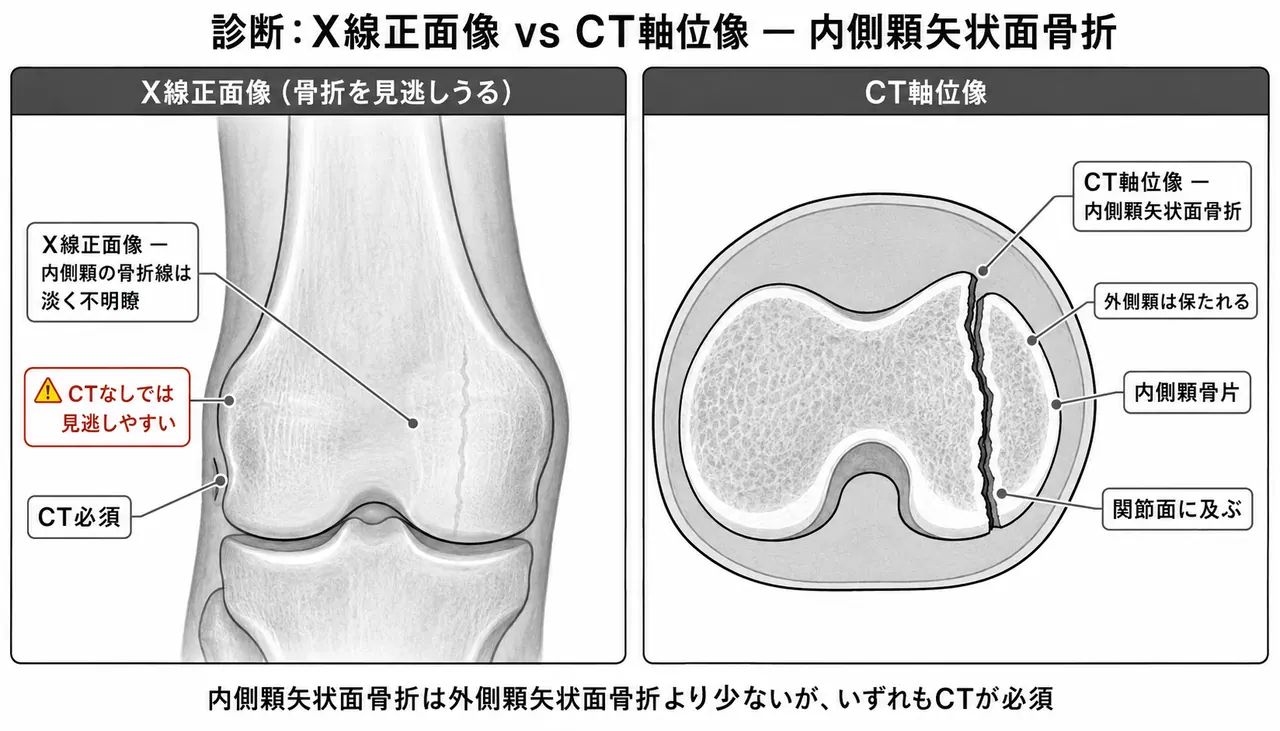 X線AP像（内側顆に縦骨折線）＋CT横断面（内側顆が矢状面で分割）— CT必須で診断