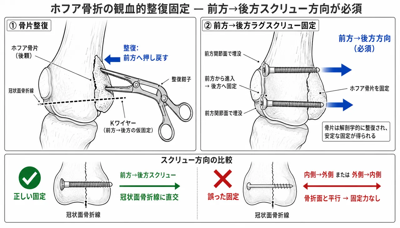 Hoffa骨折のORIF — 後方顆骨片を前方に整復し、A→P方向ラグスクリューをcountersunkで固定