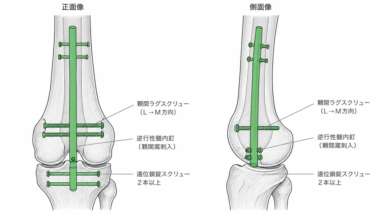 逆行性髄内釘の刺入点・遠位鎖錠スクリュー・顆間ラグスクリューの配置（術中透視正面・側面）