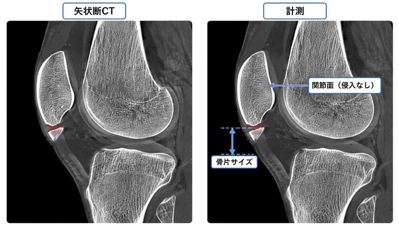 CT矢状断面（骨極骨片・関節面評価）