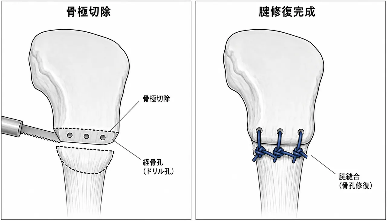 部分膝蓋骨切除術 — 小骨極切除・骨孔縫合・大腿四頭筋腱/膝蓋腱修復