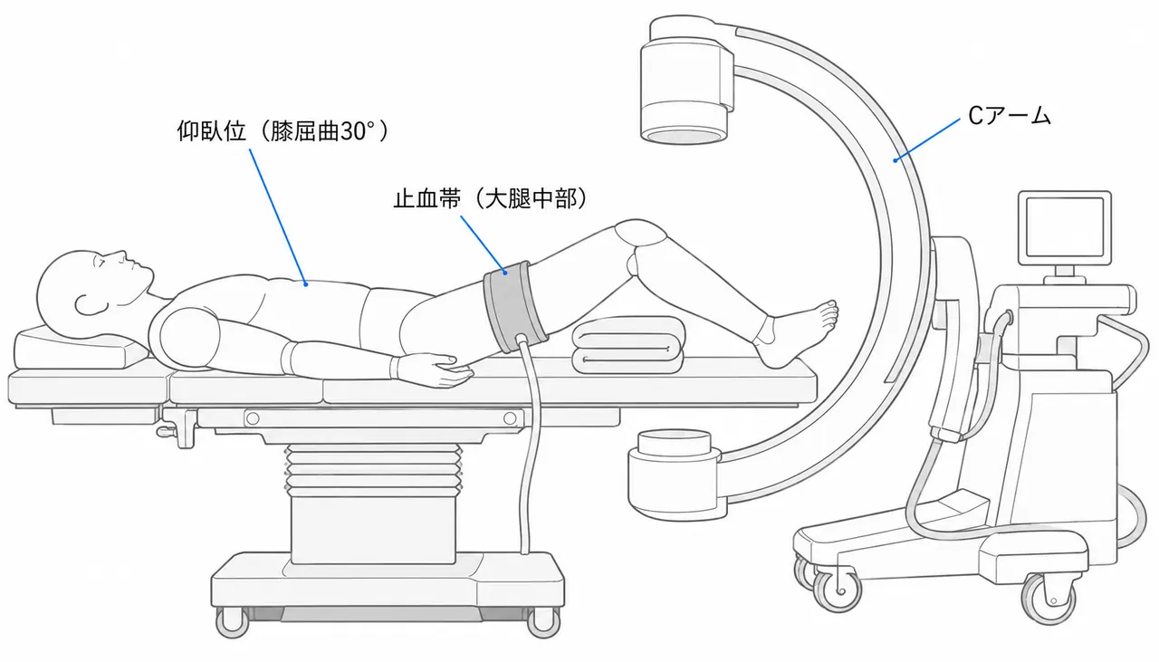 手術体位 — 仰臥位・膝屈曲30°・大腿止血帯設置