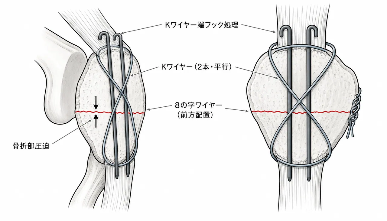 TBW手技図 — 前方縦切開・K-wire 2本平行刺入・8の字ワイヤー・骨折整復後の透視像