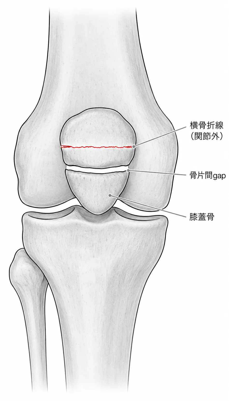 術前X線AP像（膝蓋骨横骨折線・骨片間gap評価）