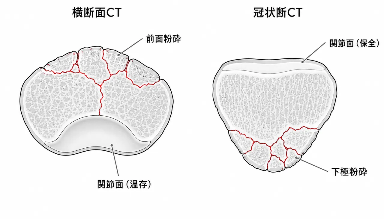 術前CT — 横断面・冠状断（関節面の温存を確認・骨片配置の把握）