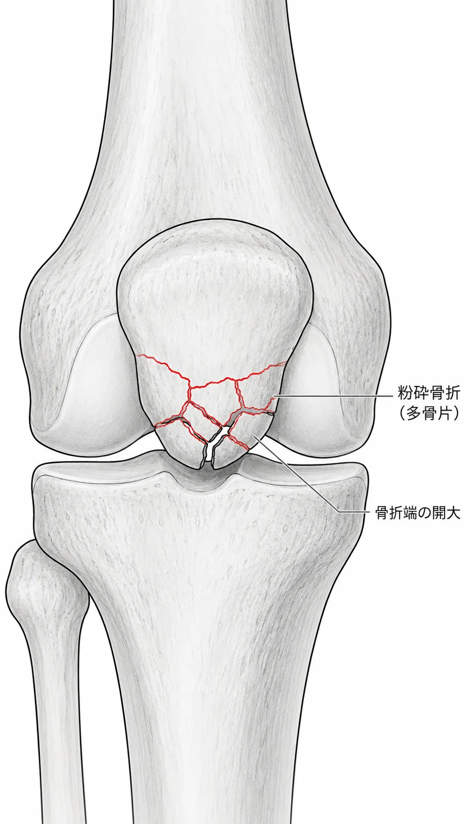 術前X線 — 正面像（膝蓋骨前面の粉砕骨折線・骨片多発）