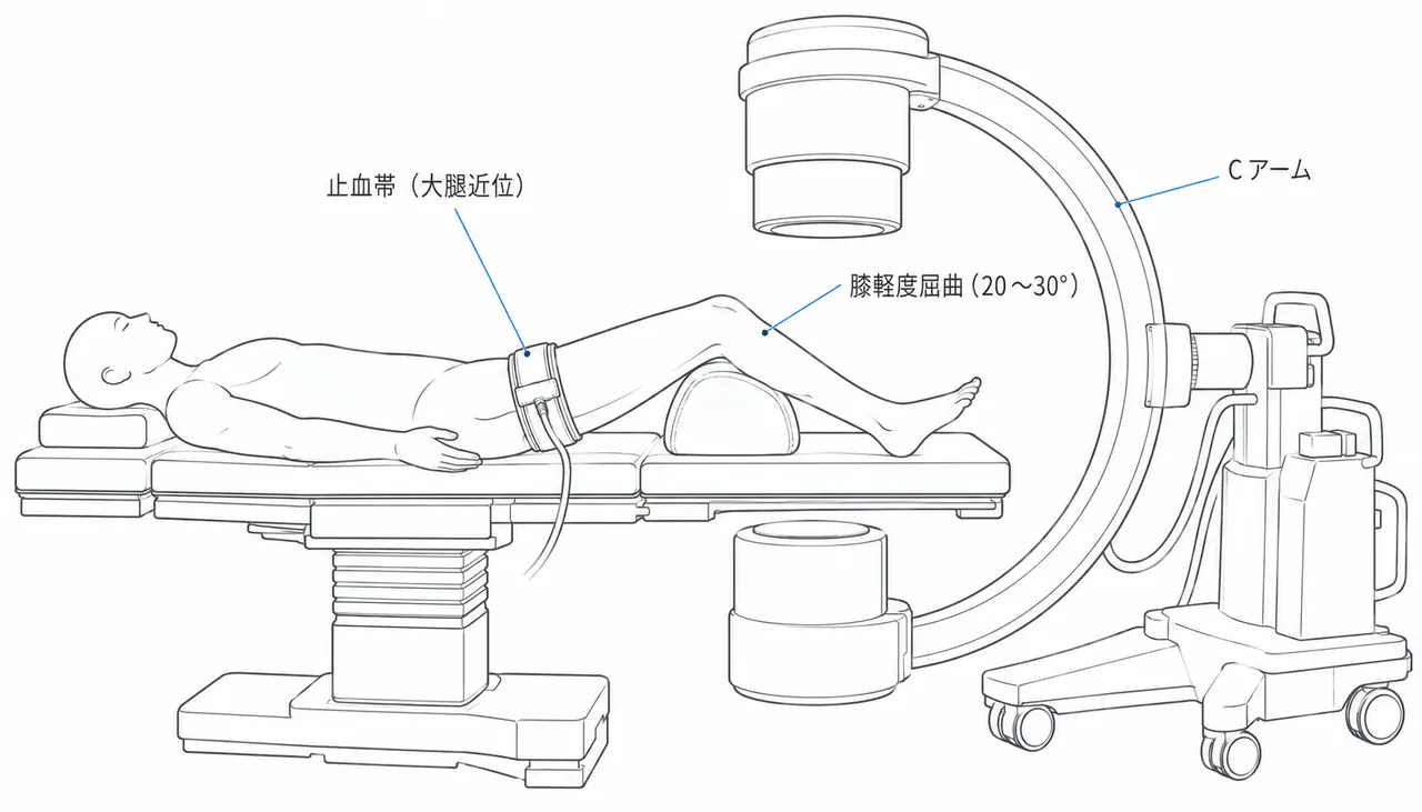 仰臥位・止血帯・Cアームセットアップ — 膝蓋骨縦骨折手術体位