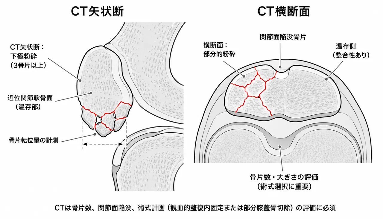 CT矢状断・横断面（膝蓋骨粉砕骨片・関節面陥没の評価）