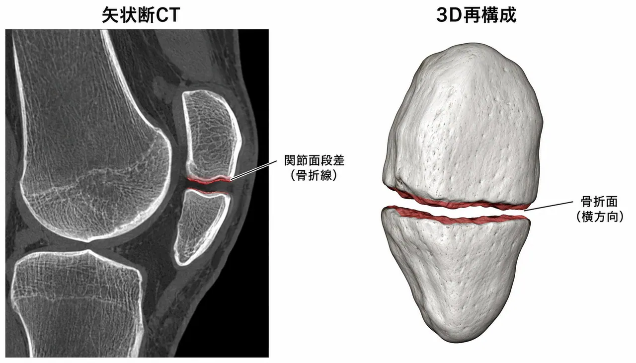CT矢状断 + 3D再構成（骨折型・転位量・関節面段差を3次元評価）