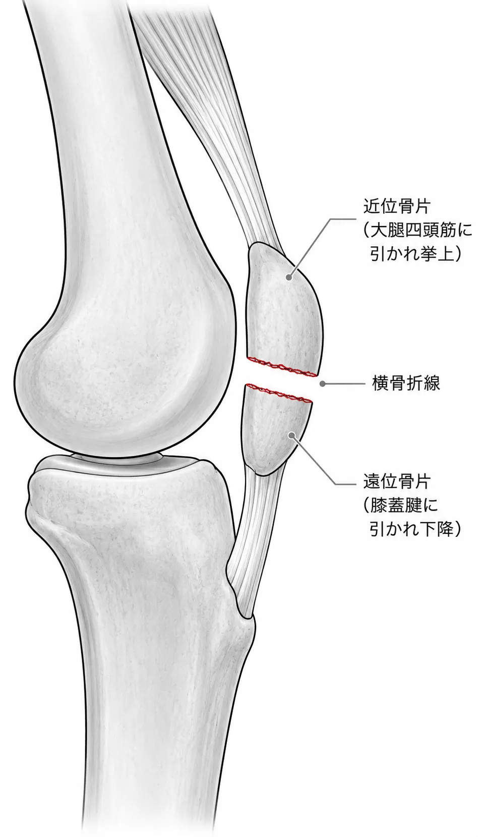 X線側面像（膝蓋骨横骨折・骨折線明瞭・転位あり）＋CT矢状断（関節面段差を評価）