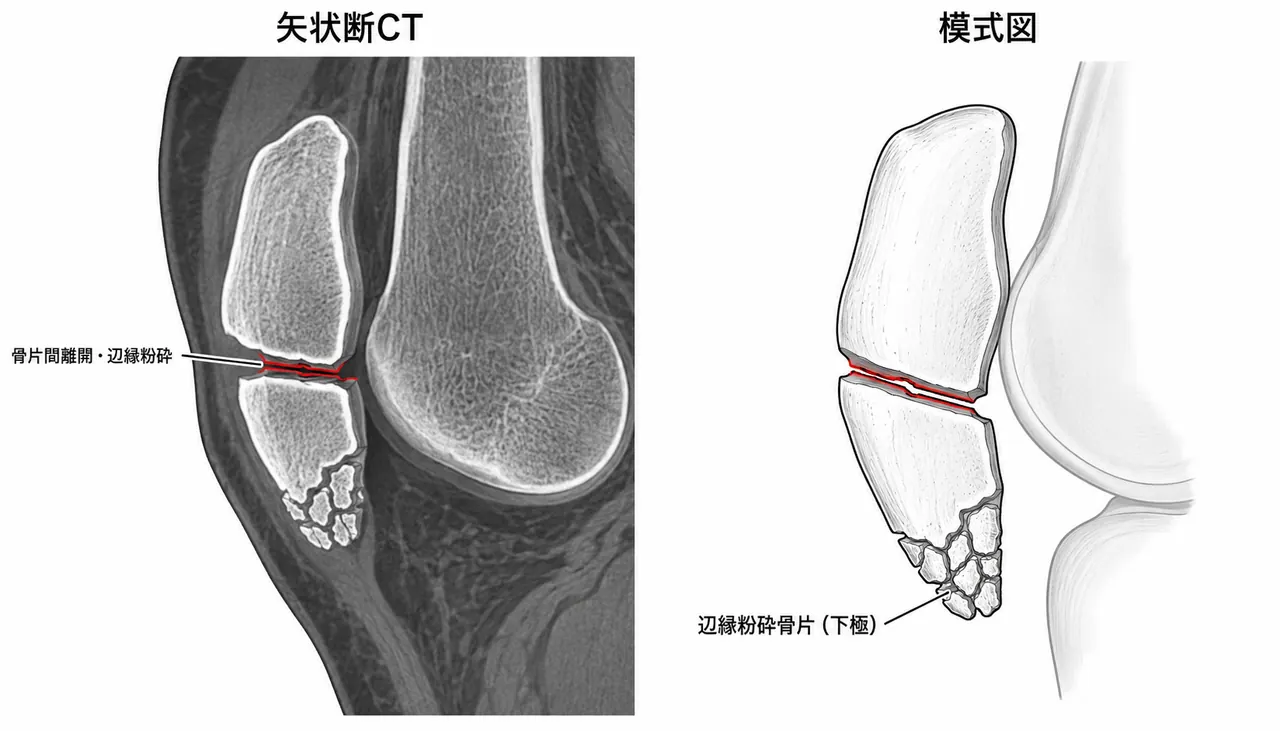 CT矢状断 — 辺縁粉砕の範囲・関節面陥没の評価