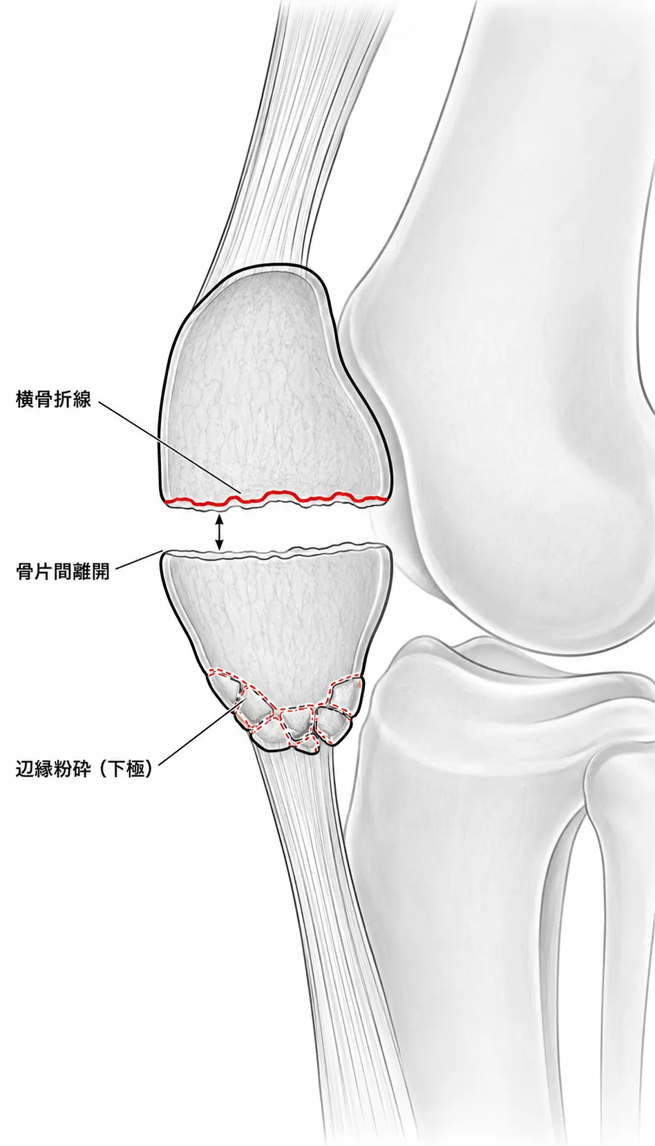 X線側面像 — 横骨折＋辺縁粉砕と骨片間転位を確認