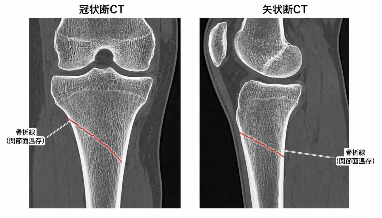 CT冠状断 + 矢状断（関節面温存を確認・骨折線の評価）