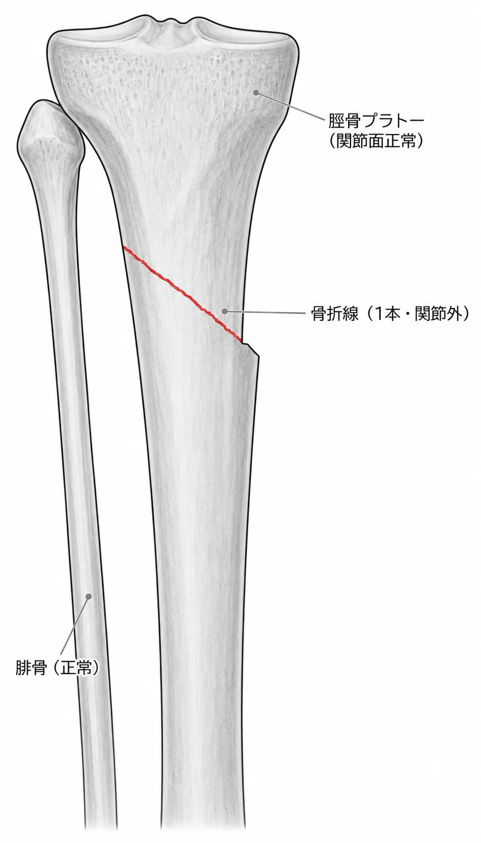 術前X線AP像（脛骨近位骨幹端に斜骨折線1本。関節面は正常）