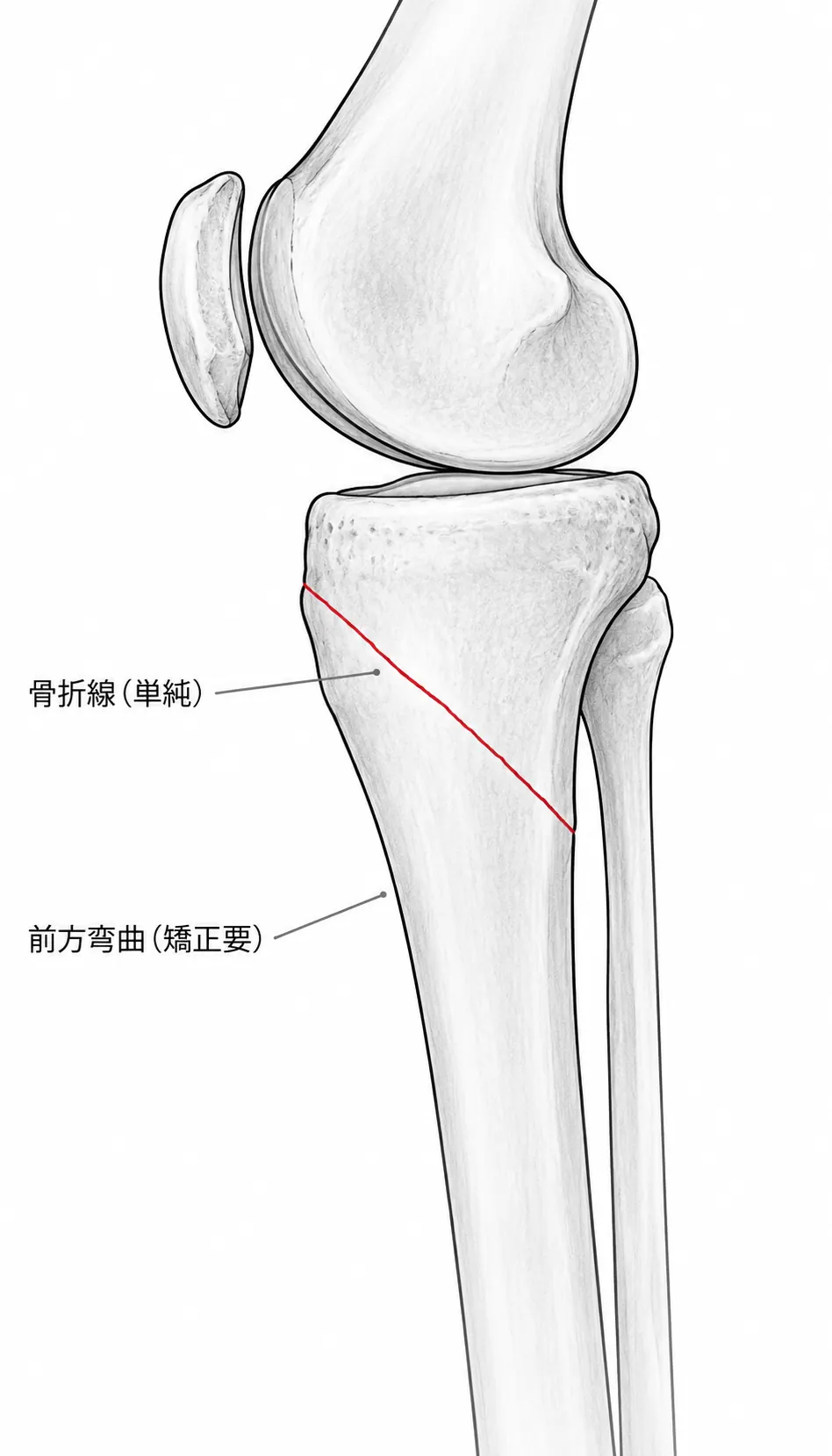 術前X線側面像（脛骨近位骨折 側面）