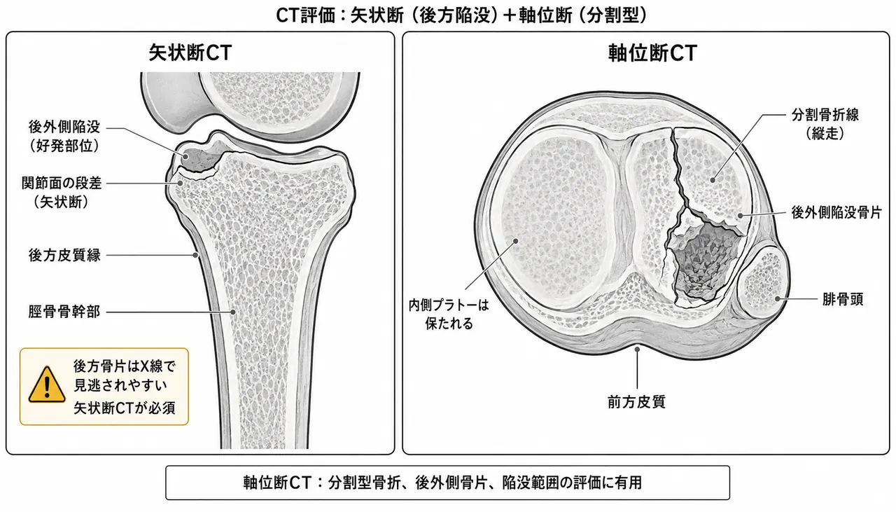 CT矢状断（後外側陥没・関節面段差）＋CT横断（split+depression骨折パターン全体像）