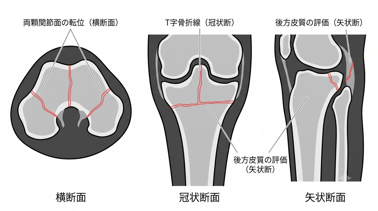 CT横断面・冠状断面・矢状断面 — 内外側両顆の関節面転位量・骨折パターンの三次元評価