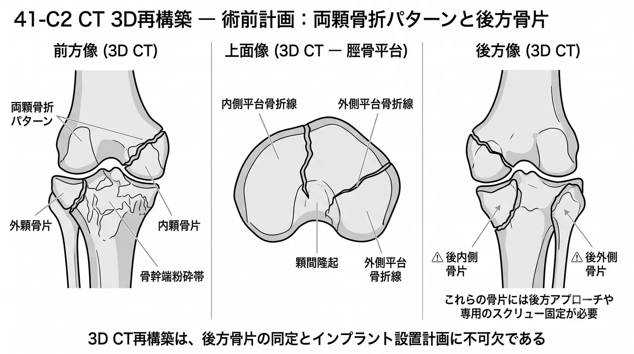 CT 3D再構成（骨折全体像の把握・術前プランニング）