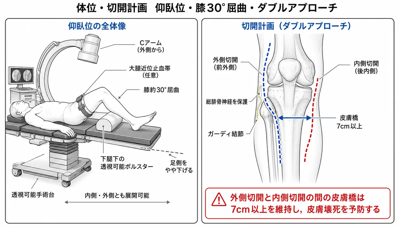 手術体位（仰臥位・膝軽度屈曲・外側および内側アプローチ可能な設定）