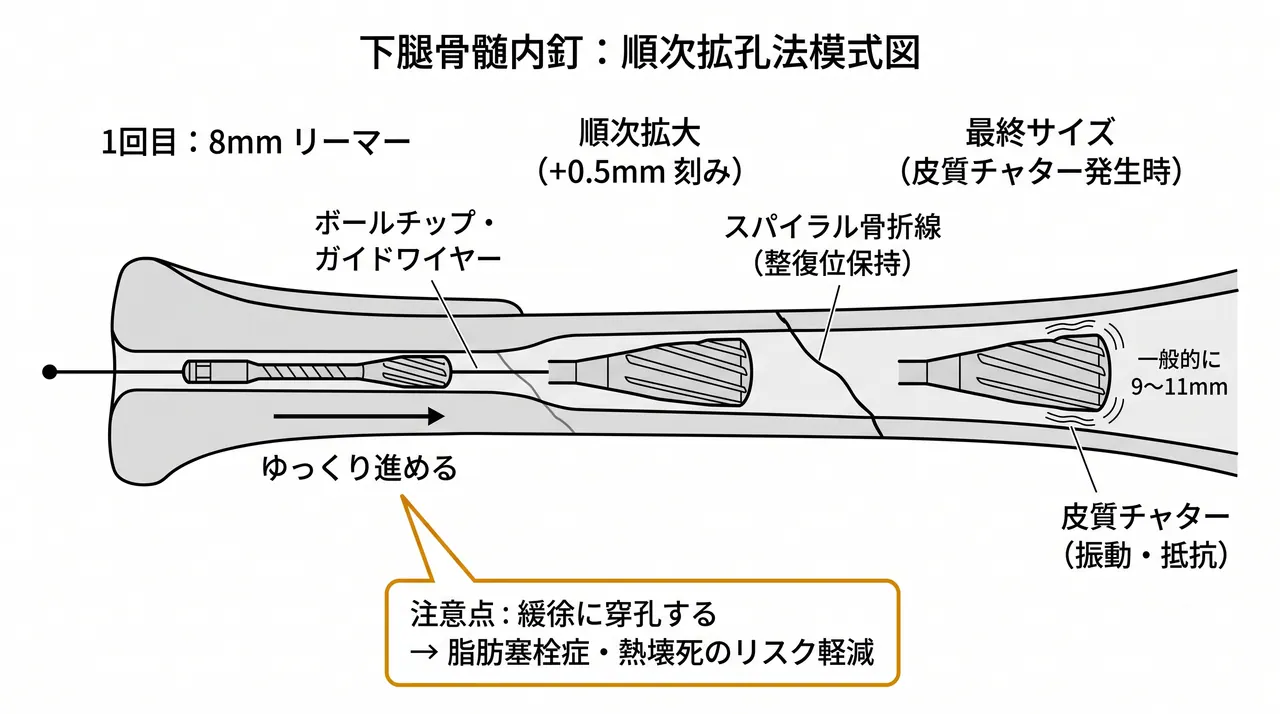 リーミング（段階的拡髄）— 8mmから0.5mm刻み、チャター感で停止