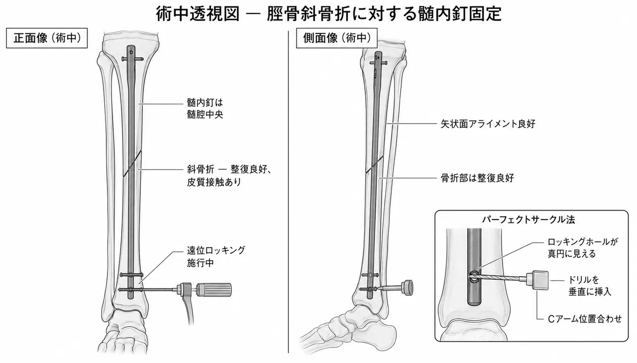 術中透視（AP/側面）— 整復位・ネイル位置確認、斜骨折の皮質接触