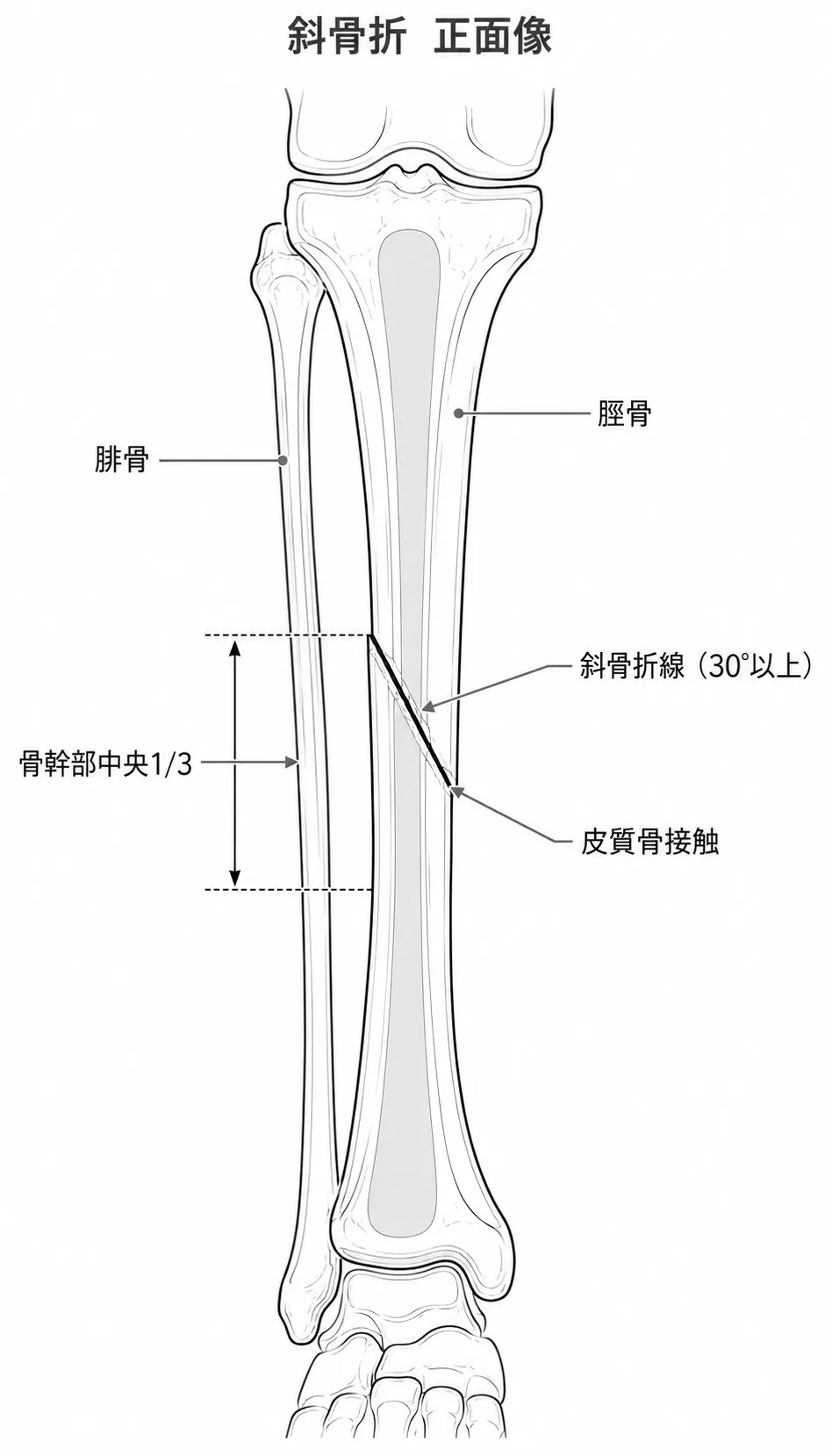 X線正面像 — 脛骨骨幹部斜骨折パターン（≥30°）、骨折端の皮質接触あり