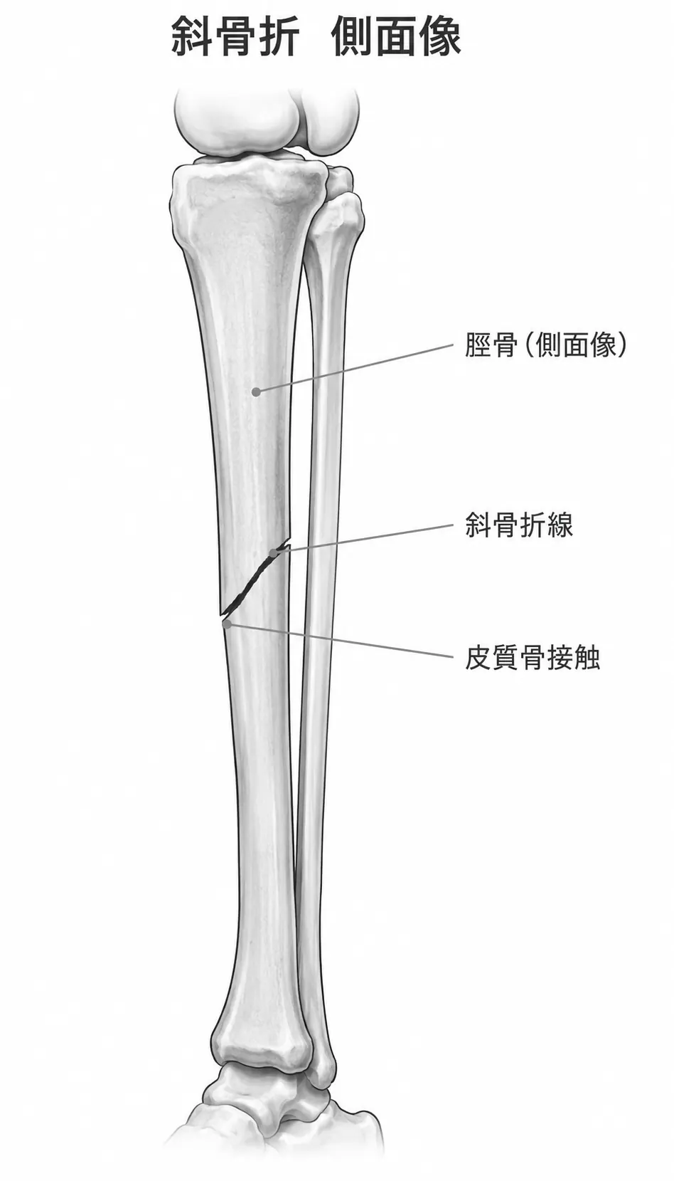 X線側面像 — 脛骨骨幹部斜骨折、側面での骨折線方向確認