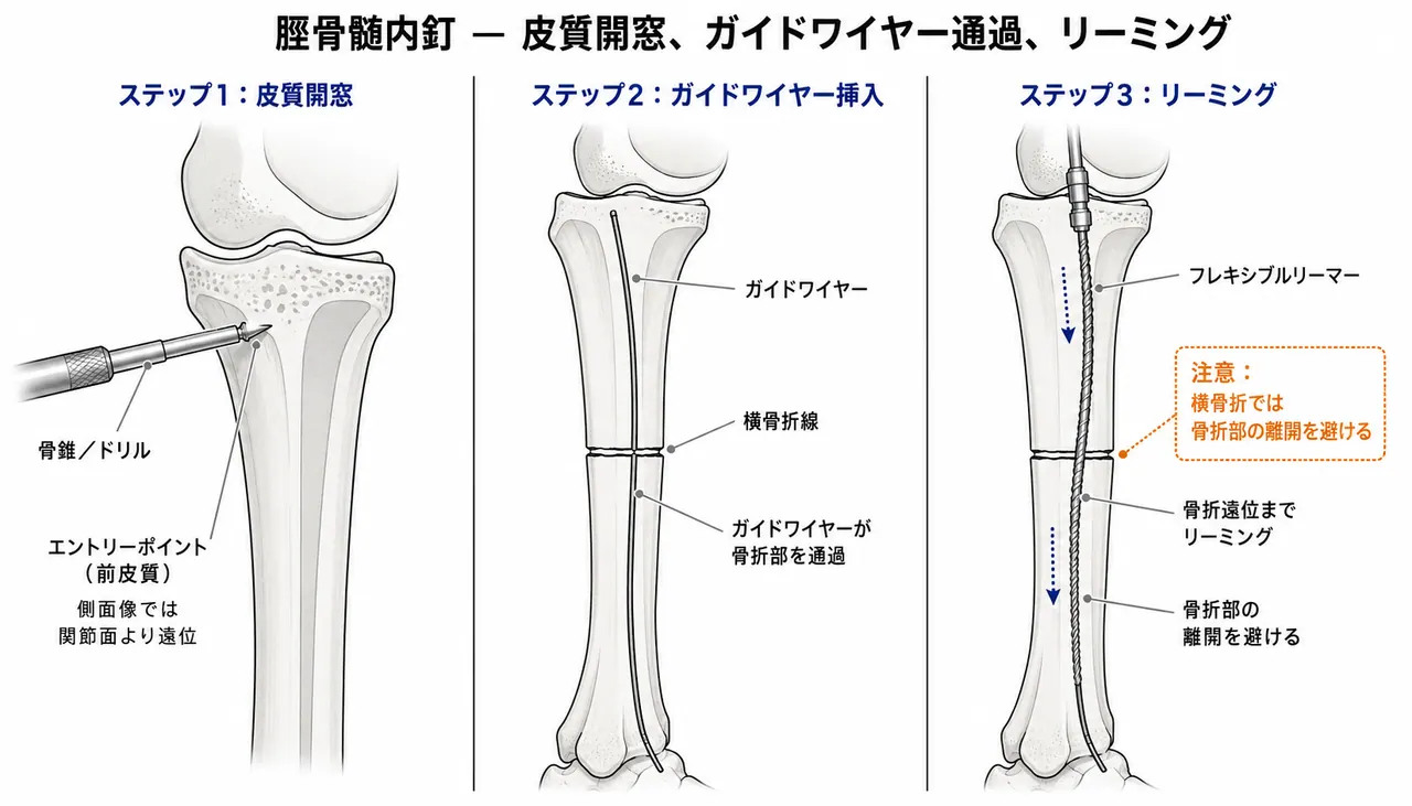 骨髄腔開口・ガイドワイヤー通過 — 脛骨髄内釘エントリー部位詳細