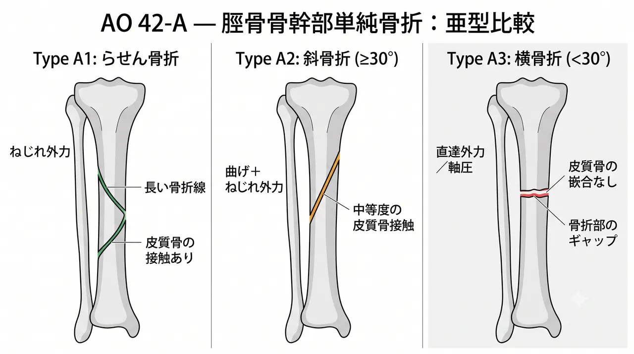 骨折パターン比較 — 42-A1（螺旋）vs 42-A2（斜骨折）vs 42-A3（横骨折）