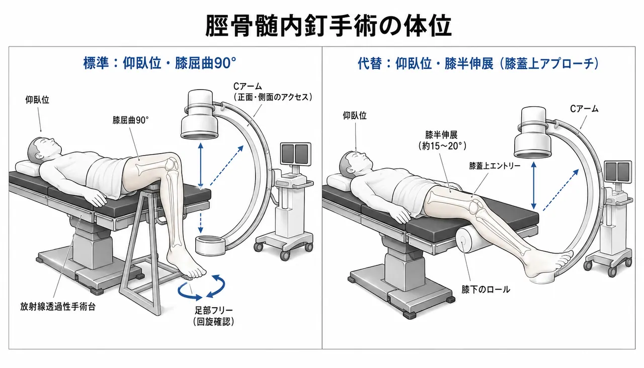手術体位 — 仰臥位・膝屈曲90°（脛骨髄内釘、透視対応）