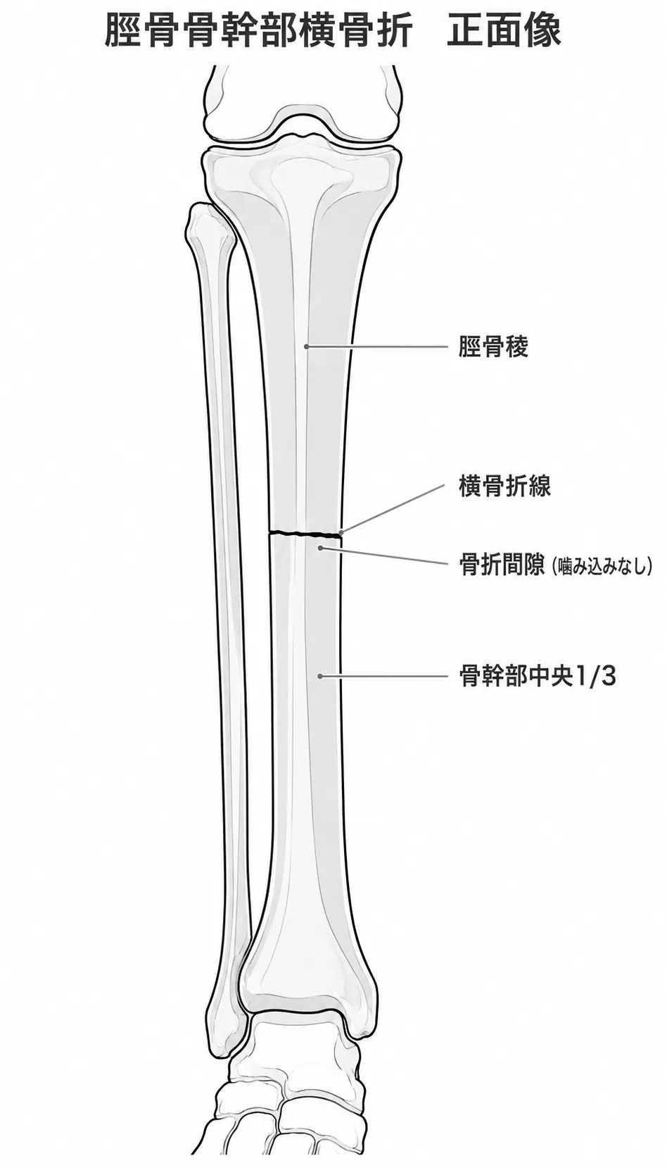 X線正面像 — 脛骨骨幹部横骨折（中央1/3・42-A3）