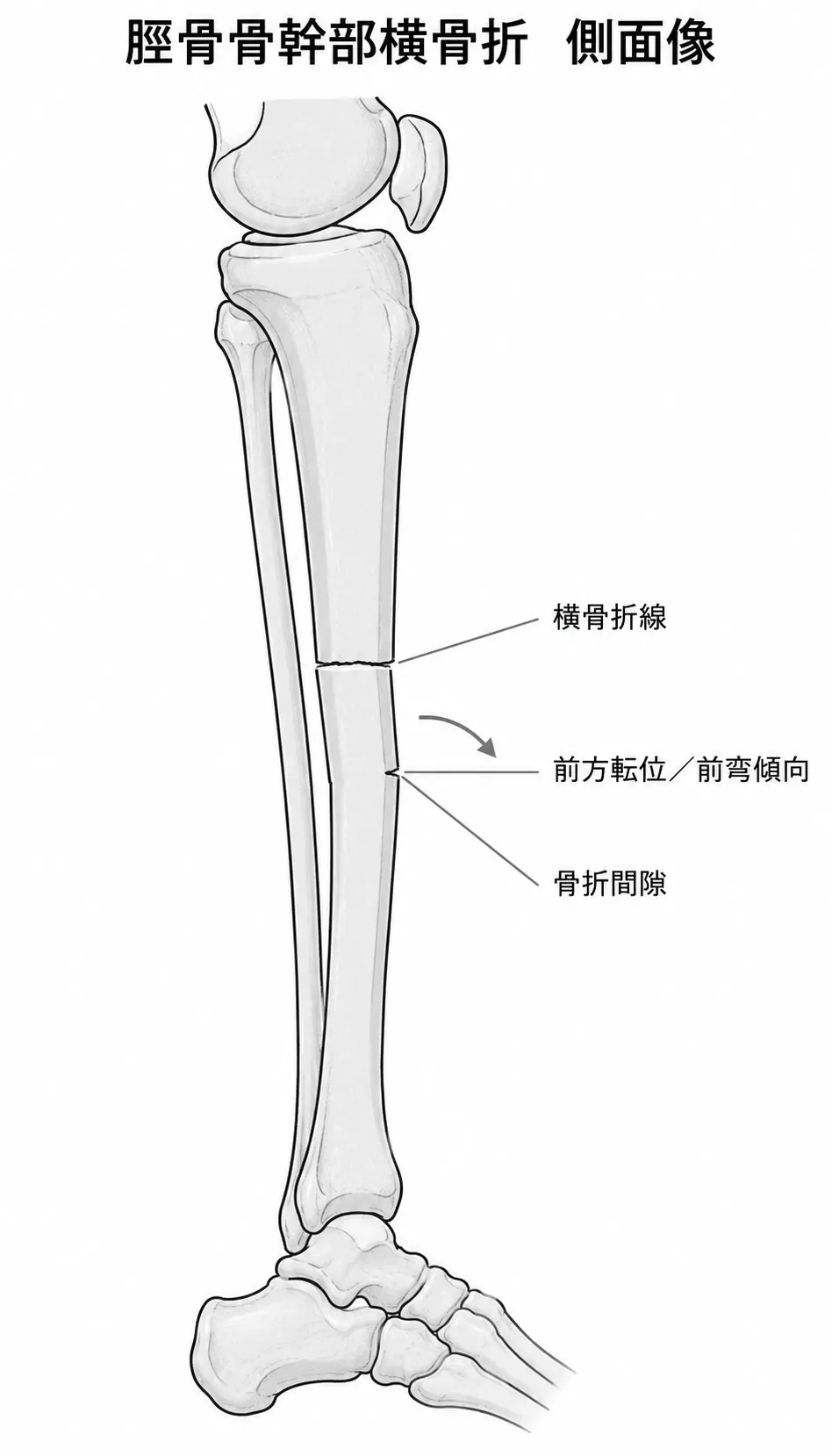 X線側面像 — 横骨折の矢状面アライメントと転位