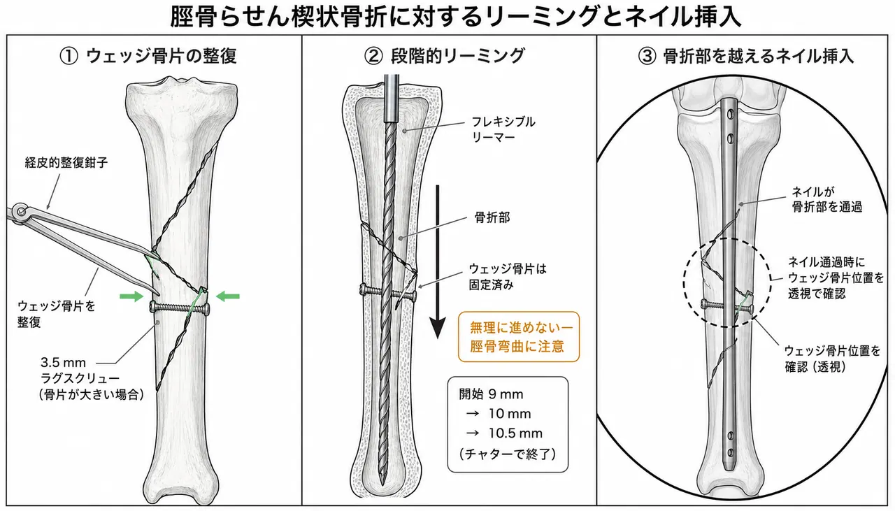 リーミング＋ネイル挿入 — 骨折部通過時の透視確認