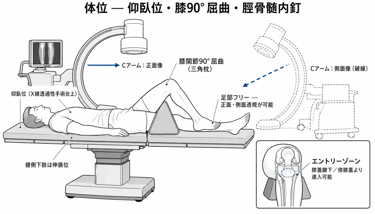 手術体位 — 仰臥位、患膝屈曲90°（脛骨髄内釘）