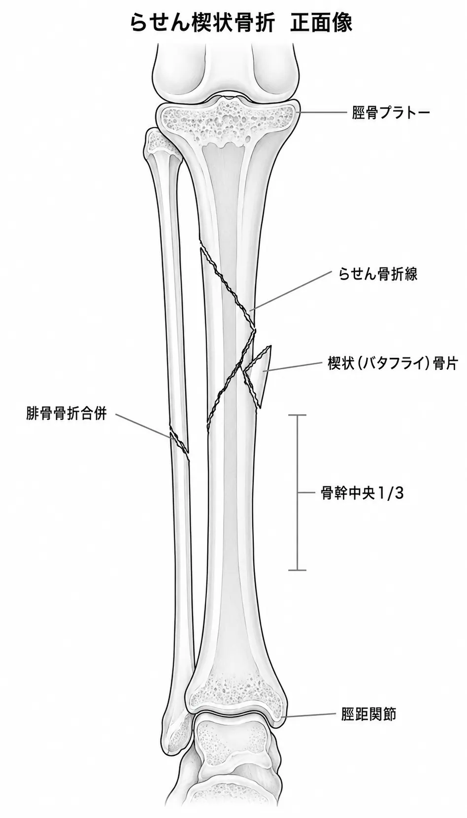 X線正面像 — 脛骨骨幹部螺旋楔状骨折（楔状骨片と腓骨骨折を含む）