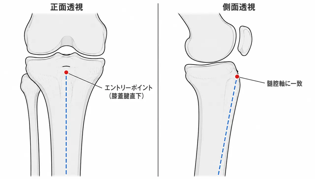 エントリーポイント — 脛骨近位エントリー（膝蓋腱直下・内外側に中立）