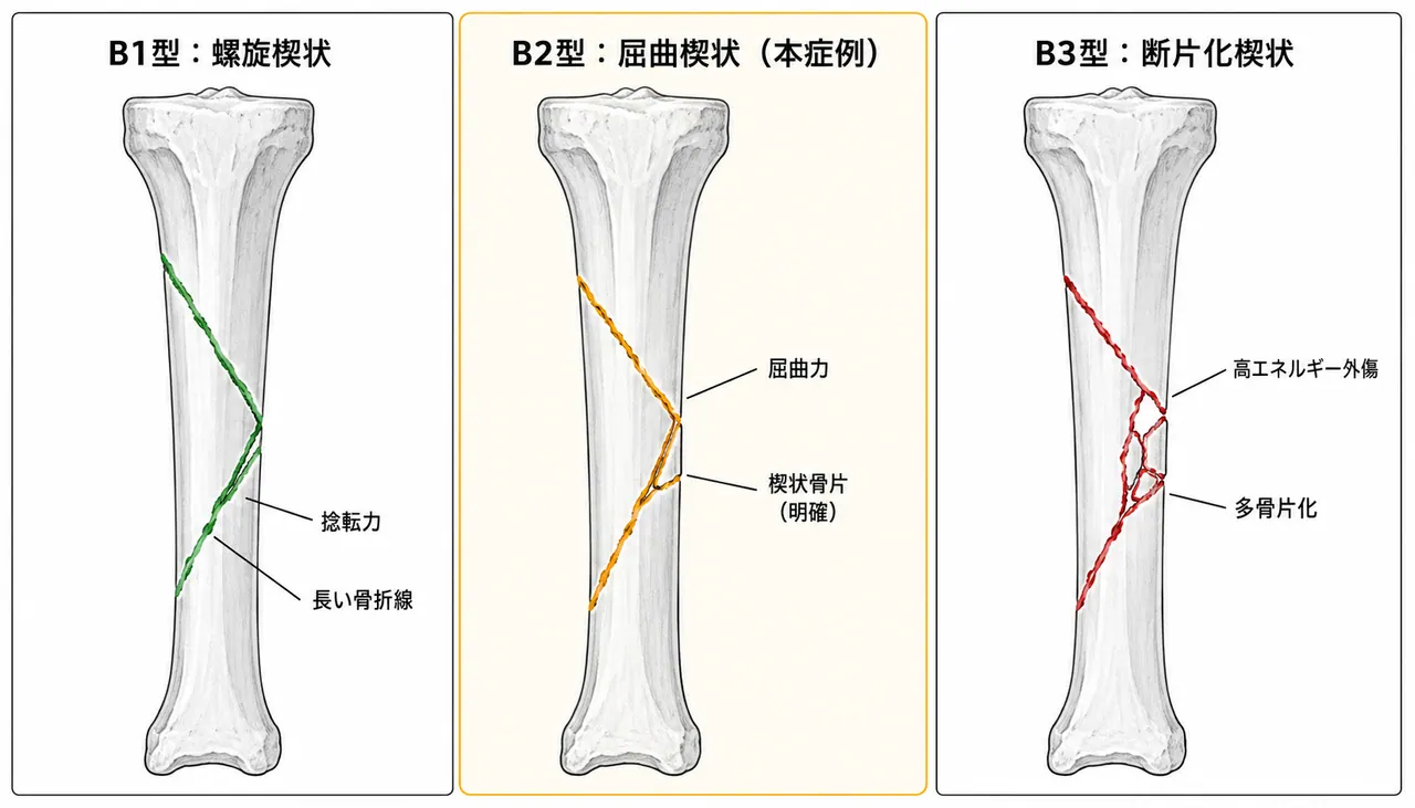 骨折パターン比較 — 42-B1（螺旋楔型）vs 42-B2（屈曲楔型）vs 42-B3（粉砕楔型）