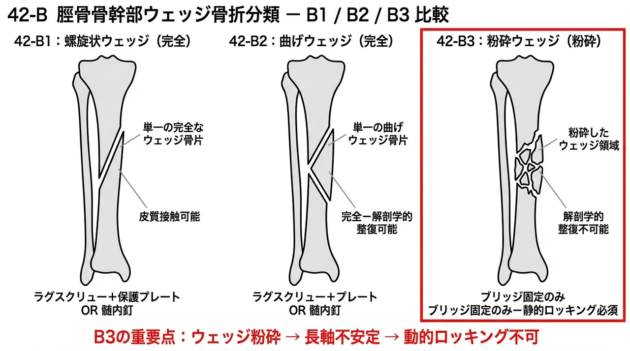 骨折パターン比較 — 42-B1（螺旋楔型）vs 42-B2（屈曲楔型）vs 42-B3（粉砕楔型）
