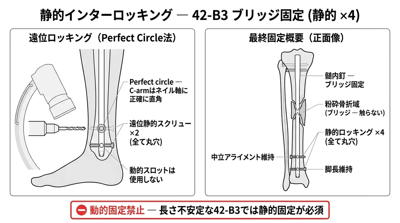 遠位静的ロッキングスクリュー（perfect circle法）＋最終固定構成（静的ロッキング4本・ブリッジ固定）