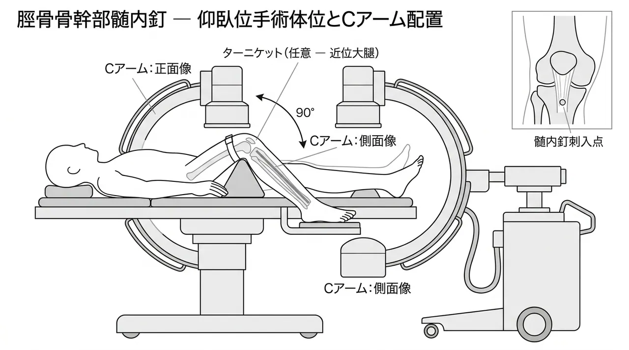 手術体位 — 仰臥位または牽引台（透視AP/側面の両方向確認）