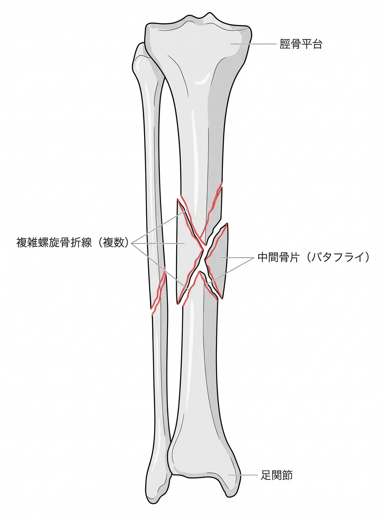 X線正面像 — 脛骨骨幹部複雑螺旋骨折（複数骨折線・中間骨片を伴う）