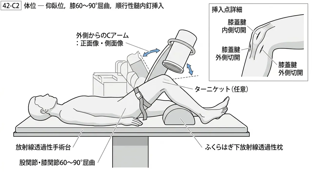 手術体位 — 仰臥位・膝屈曲30°〜60°・ターニケット装着・C-arm設置位置
