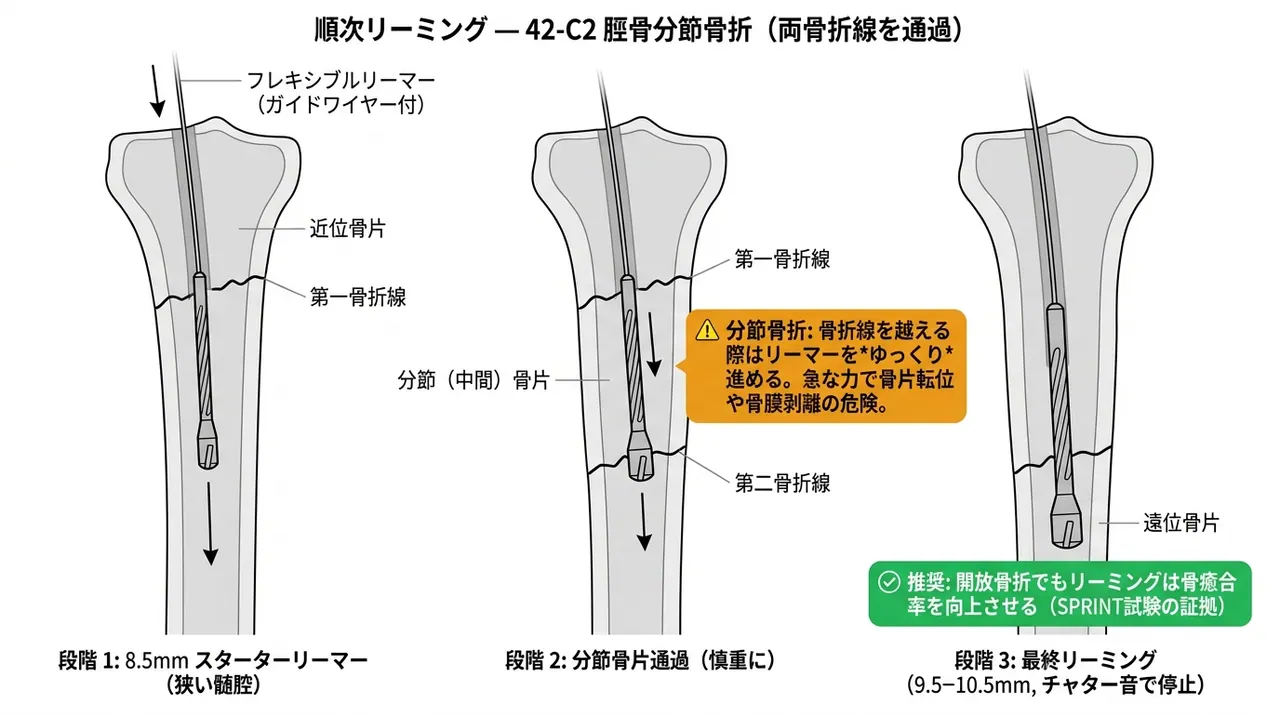 リーミング（段階的拡髄）— 分節型では骨折部を越えてのリーマー通過を慎重に行う