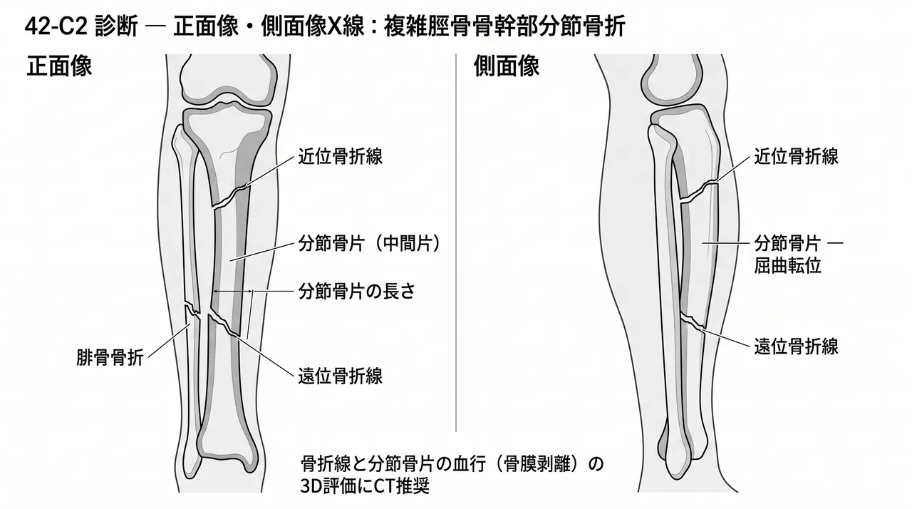 X線AP像・側面像 — 脛骨骨幹部分節骨折（2本の骨折線・中間骨片）