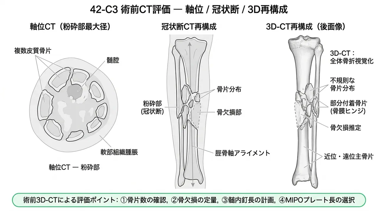 CT三次元再構成 — 粉砕骨片の分布・骨欠損の評価・術前プランニング